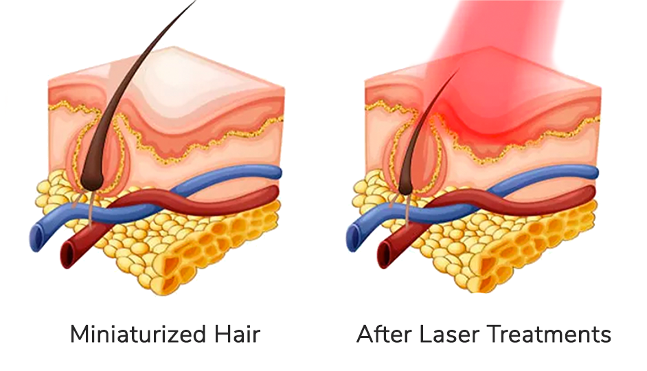 BA-LaserTreatment-Graphic