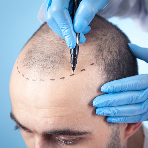 FUE Hair Transplant - GetHairMD™