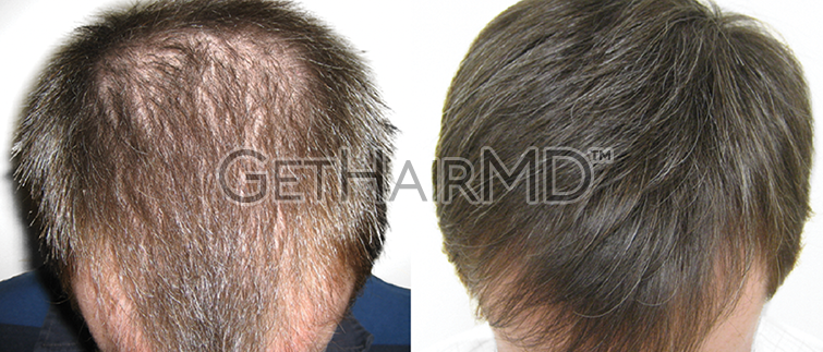 Clinical Hair Restoration Specialists | GetHairMD™