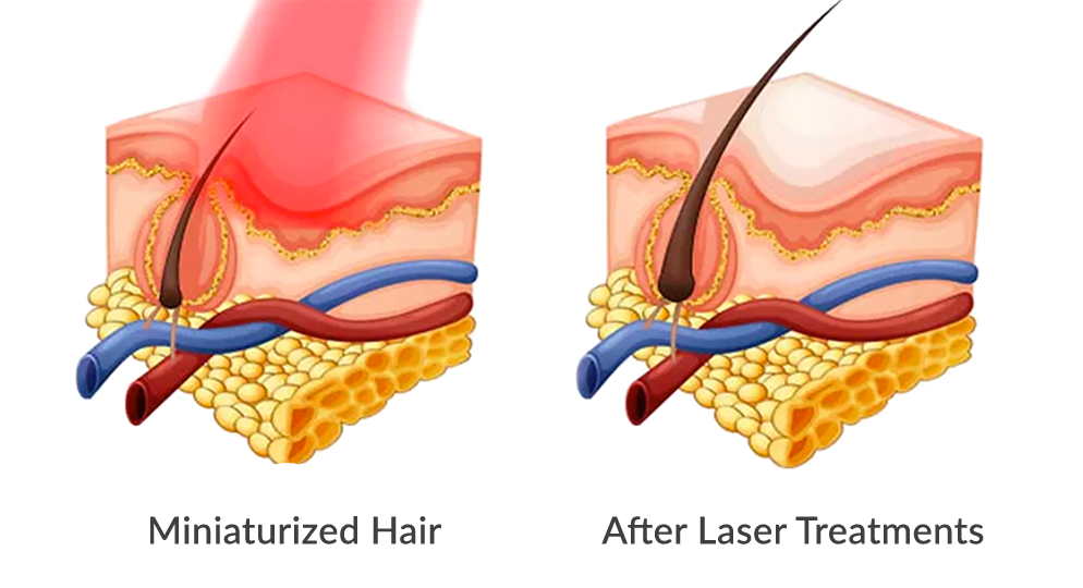 Before and After Clinical Hair Growth Laser treatments
