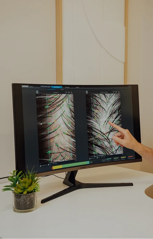 A close-up of a Samsung monitor displaying a side-by-side microscopic comparison of hair follicles for clinical tracking.
