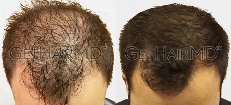 Real Patient Hair Restoration Results by GetHairMD™