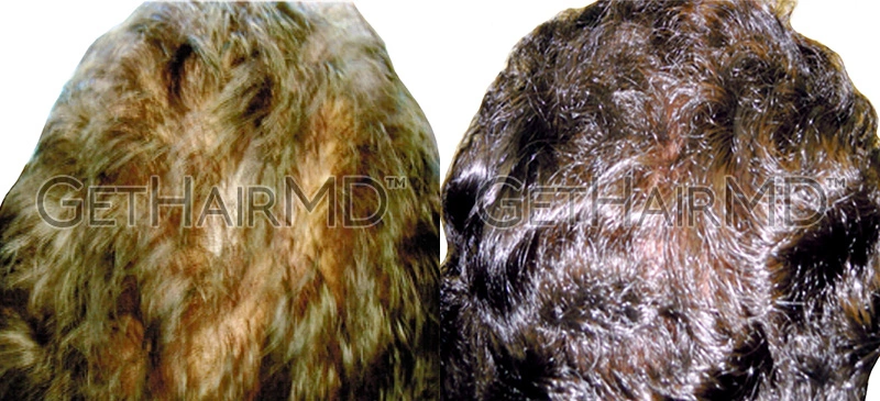 Real Patient Hair Restoration Results by GetHairMD™