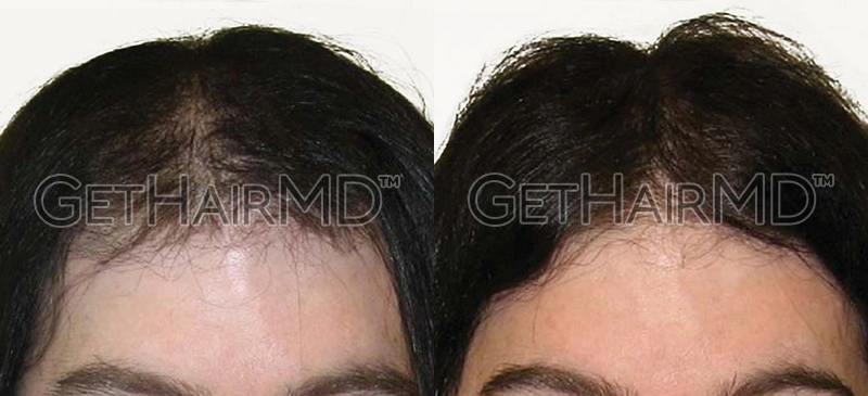 Real Patient Hair Restoration Results by GetHairMD™