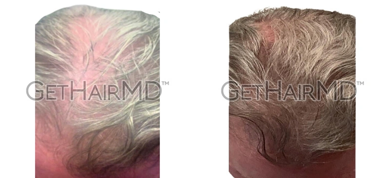 Real Patient Hair Restoration Results by GetHairMD™