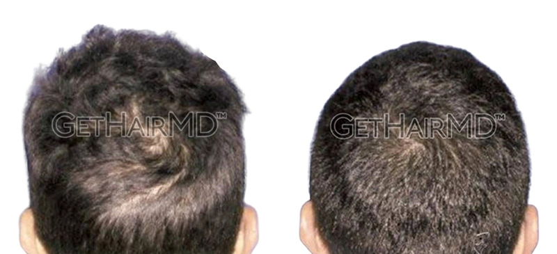 Real Patient Hair Restoration Results by GetHairMD™