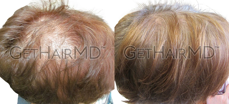 Real Patient Hair Restoration Results by GetHairMD™