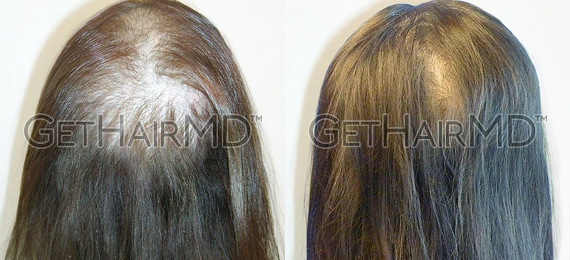 Real Patient Hair Restoration Results by GetHairMD™