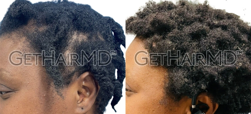 Real Patient Hair Restoration Results by GetHairMD™