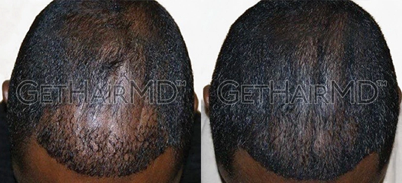 Real Patient Hair Restoration Results by GetHairMD™