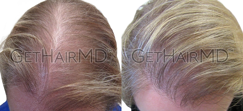 Real Patient Hair Restoration Results by GetHairMD™