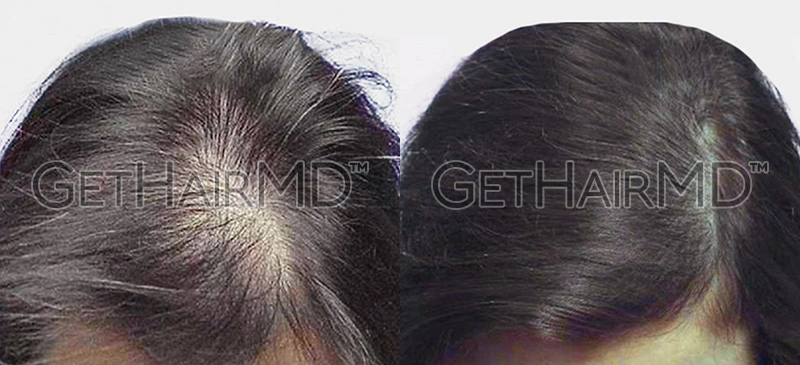 Real Patient Hair Restoration Results by GetHairMD™