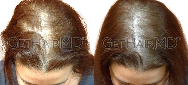 Real Patient Hair Restoration Results by GetHairMD™