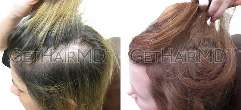 Real Patient Hair Restoration Results by GetHairMD™