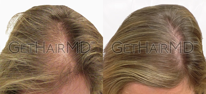 Real Patient Hair Restoration Results by GetHairMD™