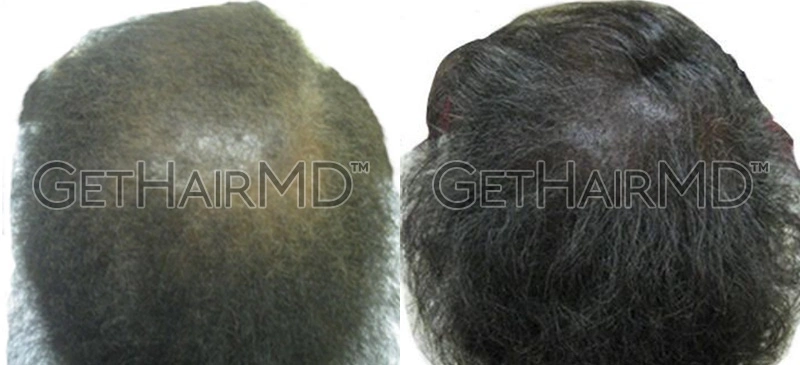 Real Patient Hair Restoration Results by GetHairMD™