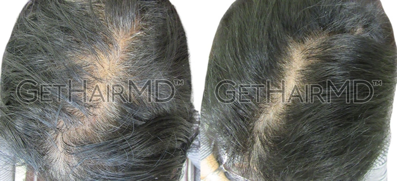 Real Patient Hair Restoration Results by GetHairMD™