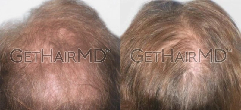 Real Patient Hair Restoration Results by GetHairMD™