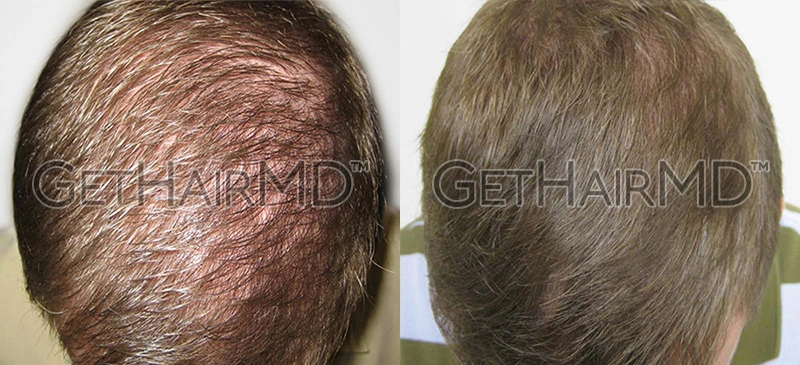 Real Patient Hair Restoration Results by GetHairMD™