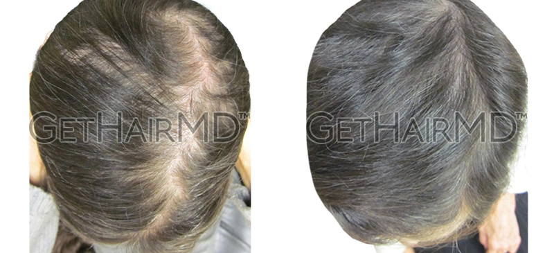 Real Patient Hair Restoration Results by GetHairMD™