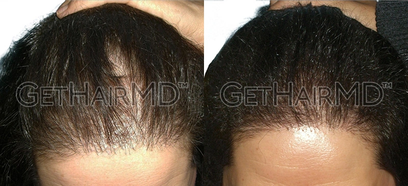 Real Patient Hair Restoration Results by GetHairMD™
