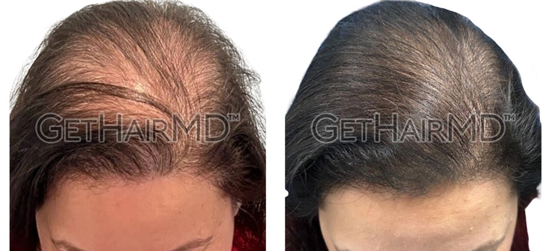 Real Patient Hair Restoration Results by GetHairMD™