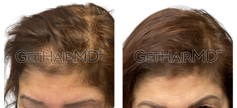 Real Patient Hair Restoration Results by GetHairMD™