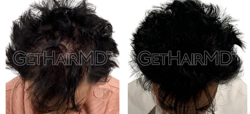 Real Patient Hair Restoration Results by GetHairMD™