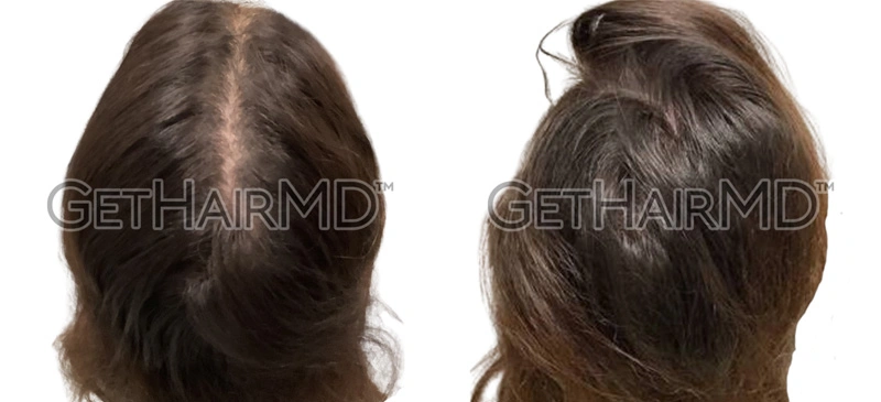 Real Patient Hair Restoration Results by GetHairMD™