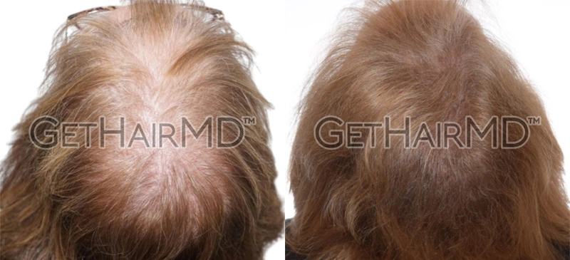Real Patient Hair Restoration Results by GetHairMD™