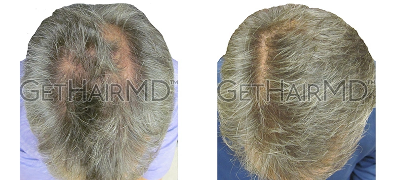 Real Patient Hair Restoration Results by GetHairMD™