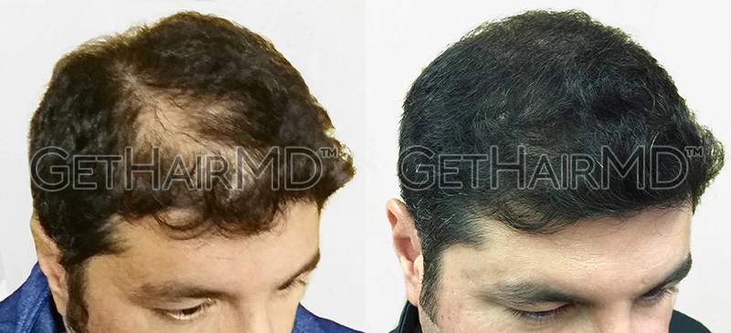 Real Patient Hair Restoration Results by GetHairMD™