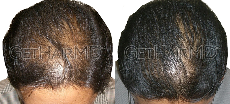 Real Patient Hair Restoration Results by GetHairMD™