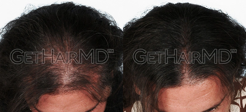 Real Patient Hair Restoration Results by GetHairMD™