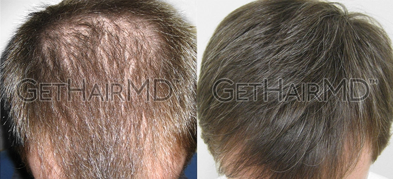 Real Patient Hair Restoration Results by GetHairMD™