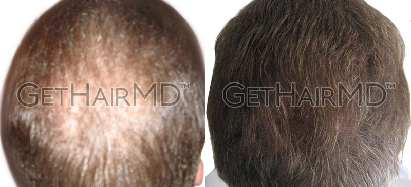 Real Patient Hair Restoration Results by GetHairMD™