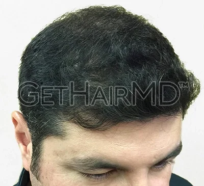 gethairmd-2-after
