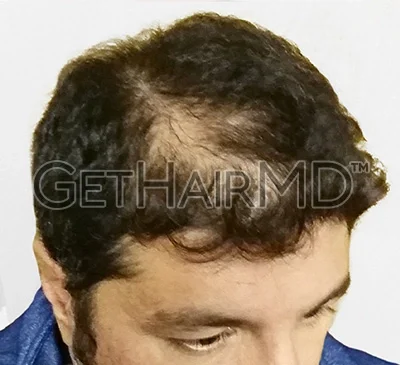 gethairmd-2-before