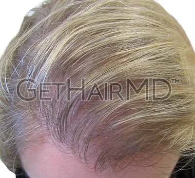 gethairmd-after
