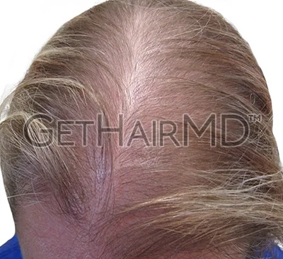 gethairmd-before